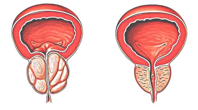 Prostatitas ir normali prostata