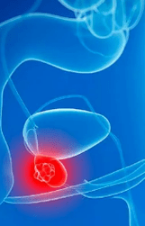 Prostatitas