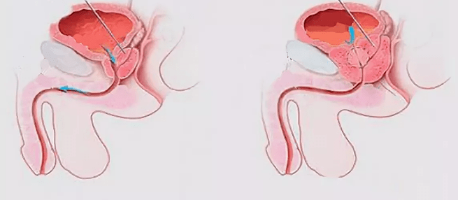 Vyrų prostatito požymiai