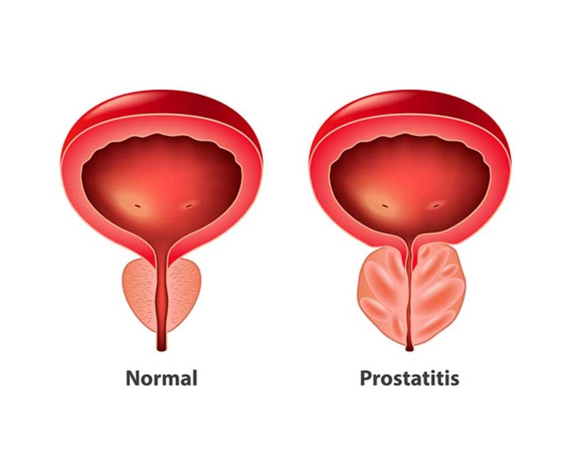 normali ir uždegiminė prostata