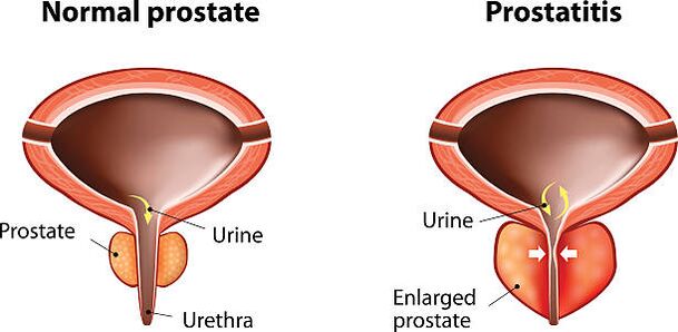 normalus ir uždegtas prostata