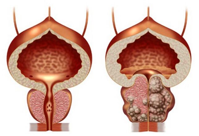 sveika prostata ir prostatos adenoma